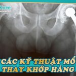 Các kỹ thuật mổ thay khớp háng hiện nay