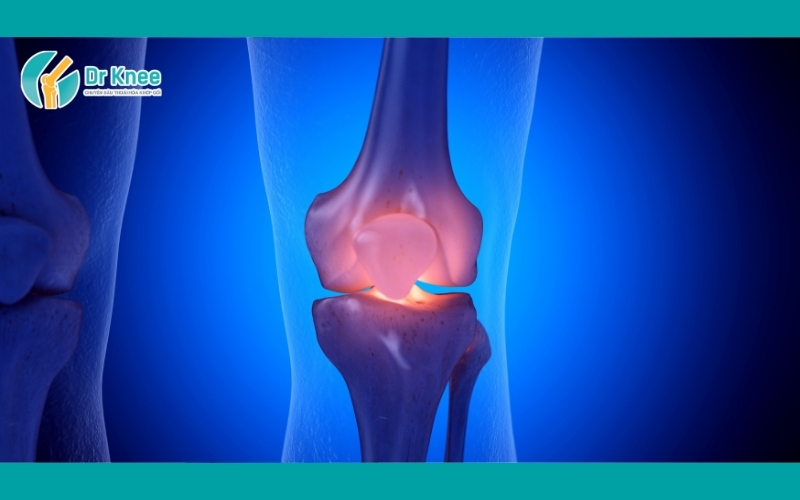 Hẹp Khe Khớp Gối: Nguyên Nhân, Triệu Chứng Và Cách Điều Trị