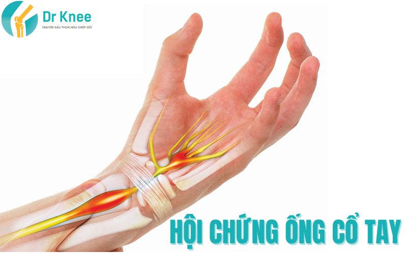 3 Bài Tập Điều Trị Hội Chứng Ống Cổ Tay Hiệu Quả