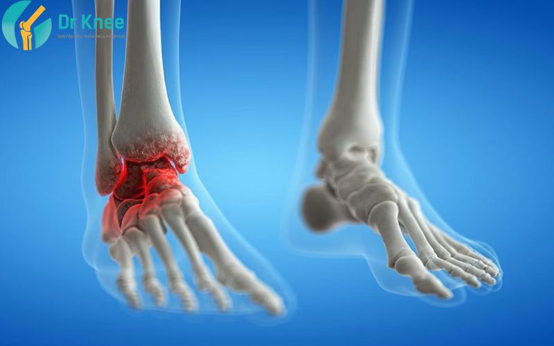 viêm khớp cổ chân là gì