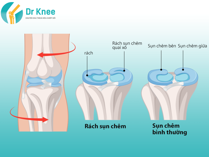 Chi Phí Mổ Rách Sụn Chêm Giá Bao Nhiêu? BHYT Có Chi Trả Không?