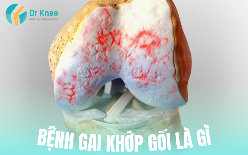 Bệnh gai khớp gối là gì?