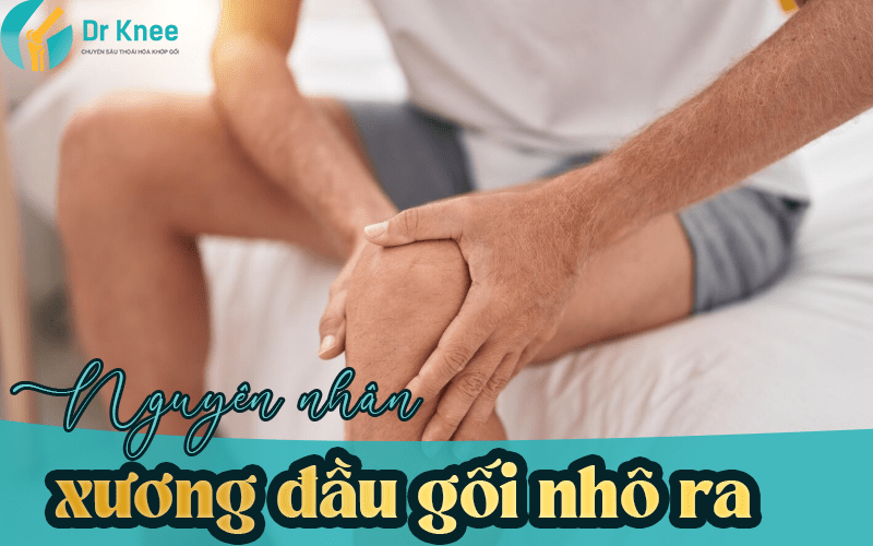 Nguyên nhân xương đầu gối nhô ra