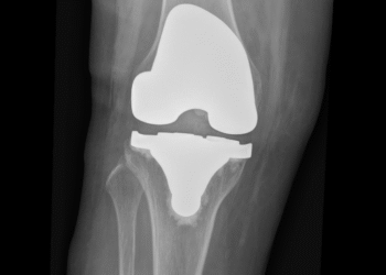 ảnh sau thay khớp gối